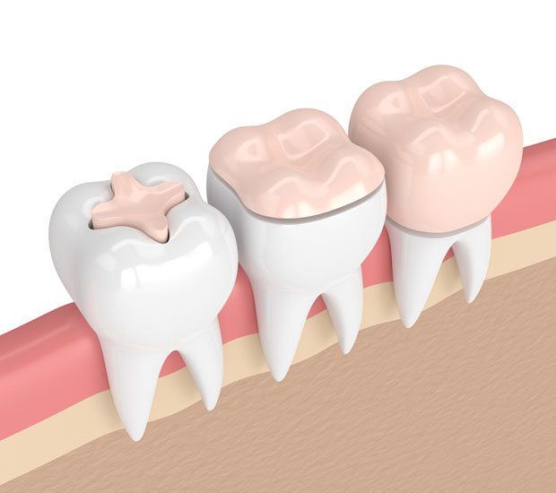 Phoenix Dental Inlays and Onlays